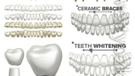 دانلود وکتور المان های داندانپزشکی، دندان و ایمپلنت دندان Dental Implant Illustration